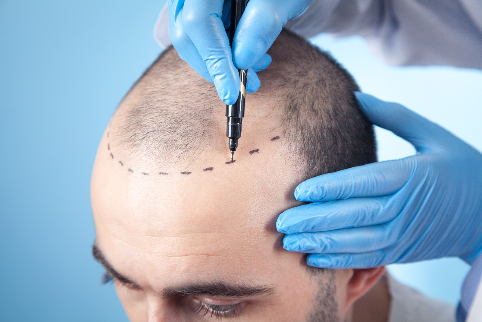 Hair Transplantation